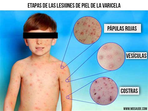 o que é varicela
